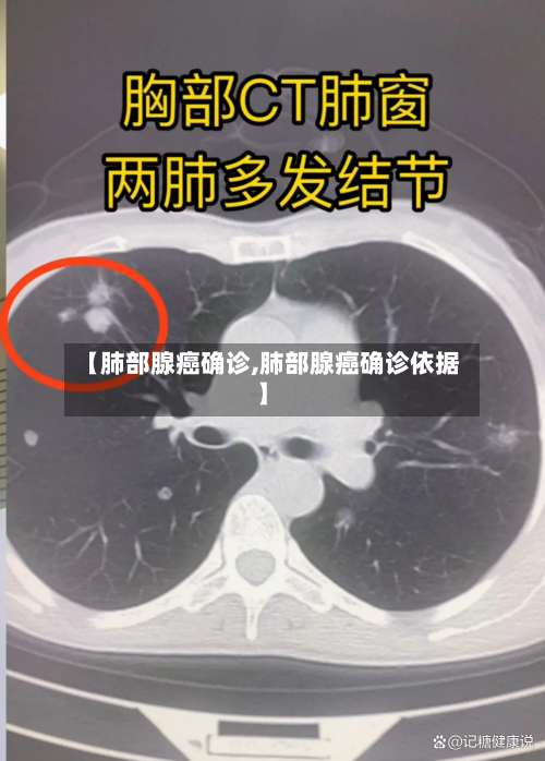 【肺部腺癌确诊,肺部腺癌确诊依据】