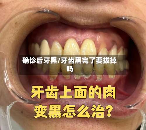 确诊后牙黑/牙齿黑完了要拔掉吗-第2张图片