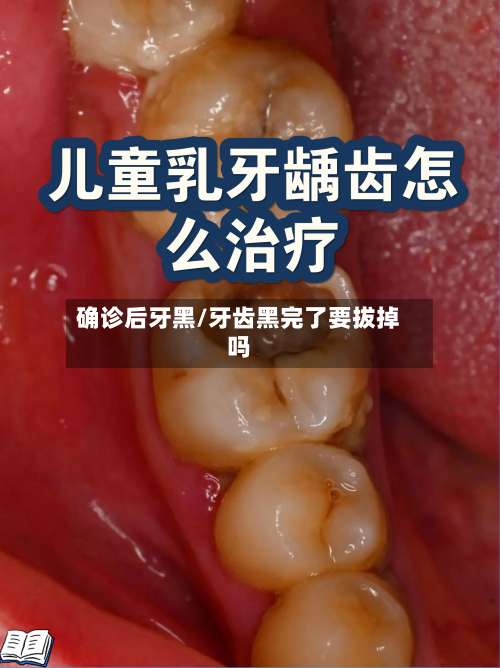 确诊后牙黑/牙齿黑完了要拔掉吗-第3张图片