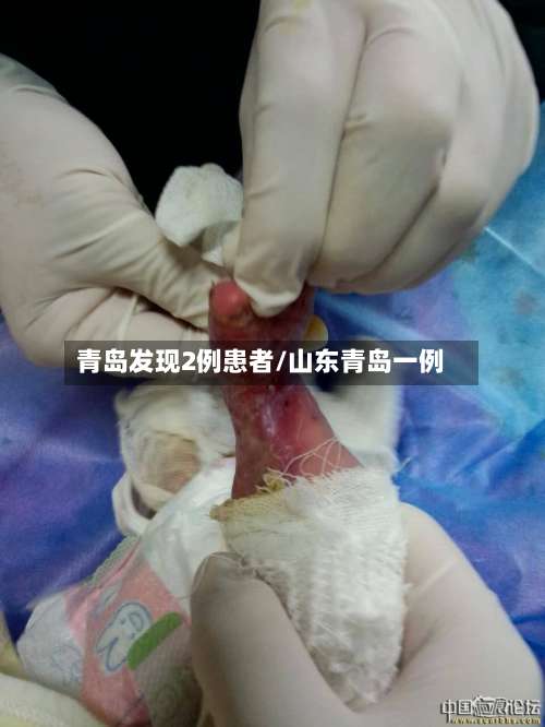 青岛发现2例患者/山东青岛一例-第3张图片