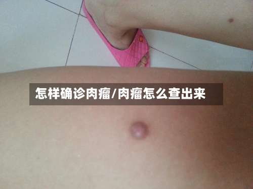 怎样确诊肉瘤/肉瘤怎么查出来