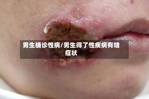 男生确诊性病/男生得了性疾病有啥症状-第3张图片