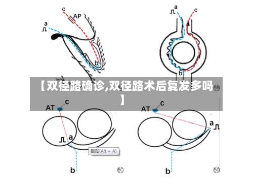 【双径路确诊,双径路术后复发多吗】