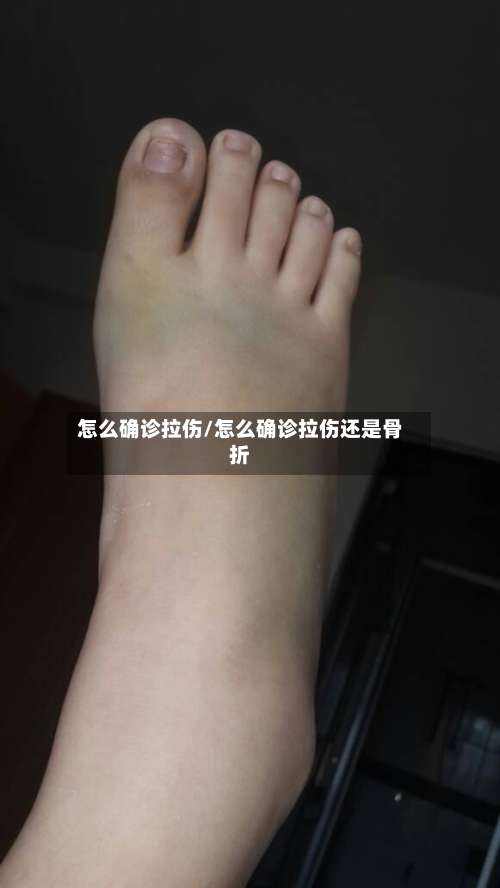 怎么确诊拉伤/怎么确诊拉伤还是骨折