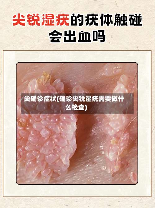 尖确诊症状(确诊尖锐湿疣需要做什么检查)-第3张图片